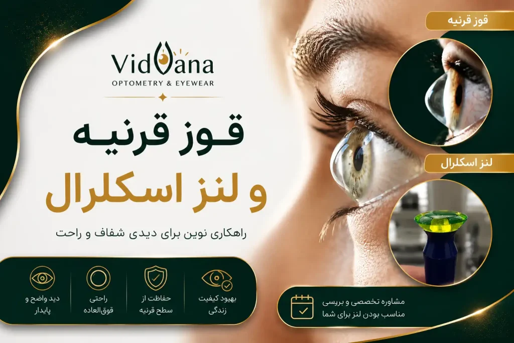 قوز قرنیه و لنز اسکلرال